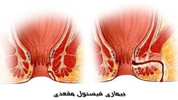 فیستول مقعدی چیست و چگونه در یک روز آن را درمان کنیم؟